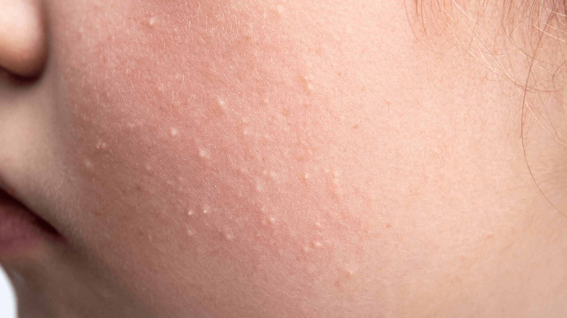Close-up of cheek with visible whiteheads, textured skin, and enlarged pores