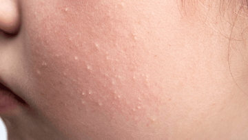 Close-up of cheek with visible whiteheads, textured skin, and enlarged pores