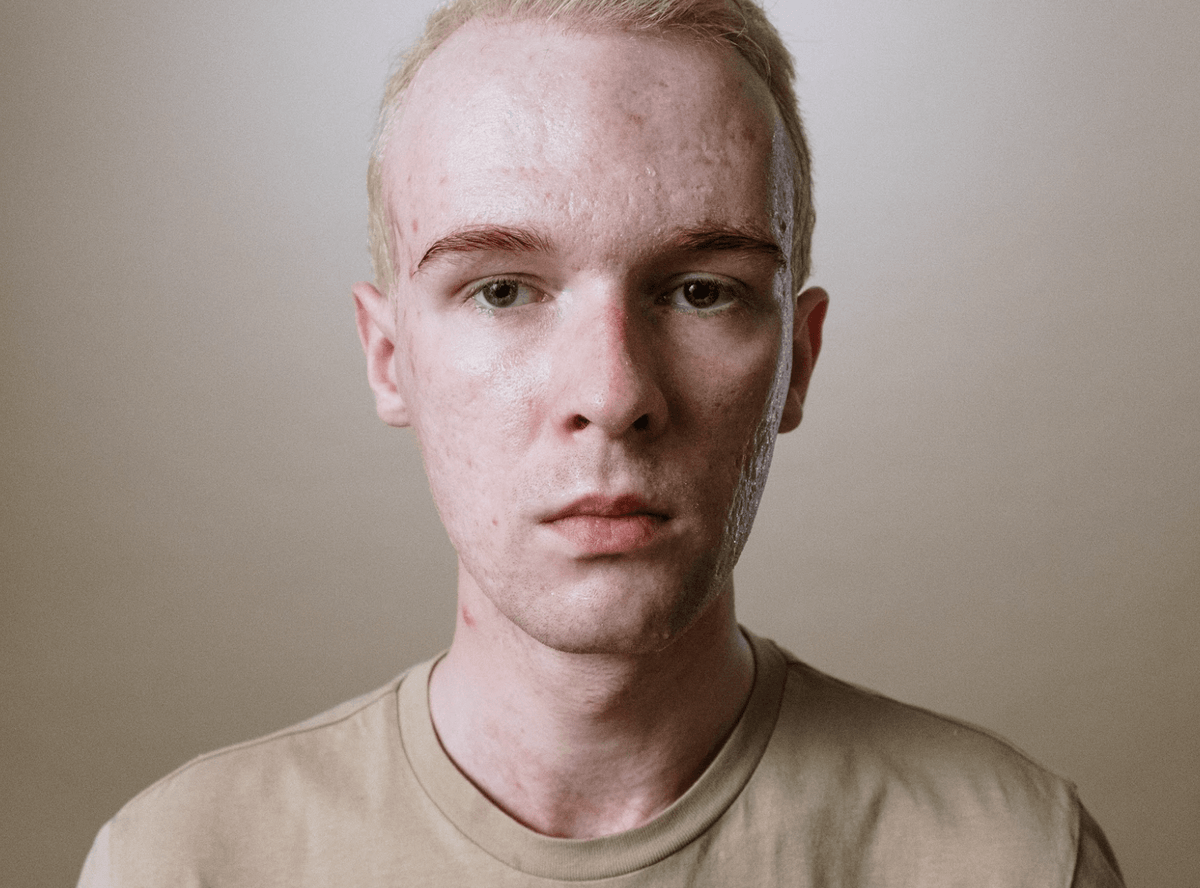 Close-up portrait of a man with visibly irritated, blemished facial skin