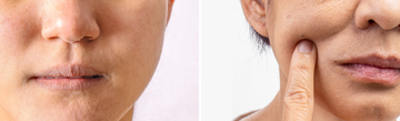Close-up comparison of dehydrated facial skin with flaking beside dry skin being pressed on a cheek