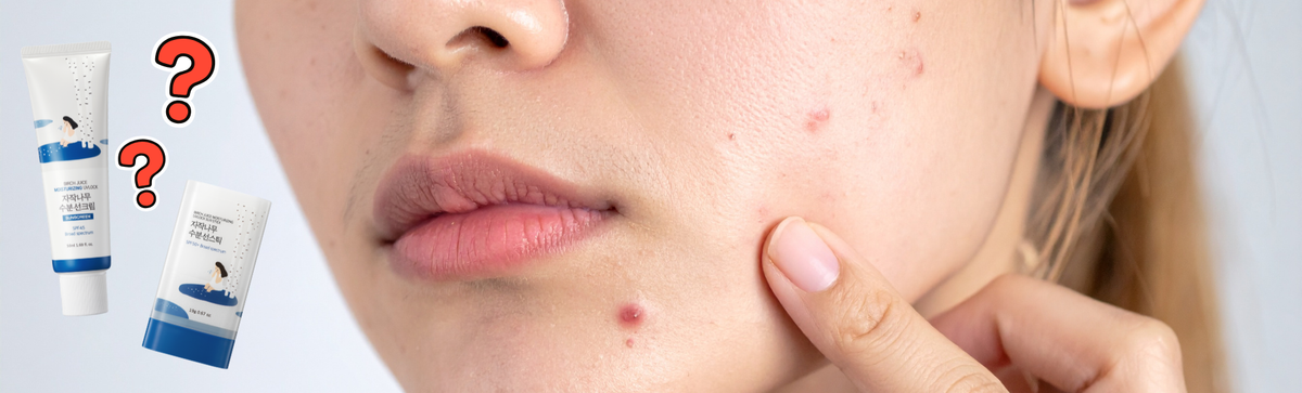 Close-up of a face with blemishes as a finger points to one beside two sunscreen tubes