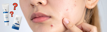 Close-up of a face with blemishes as a finger points to one beside two sunscreen tubes