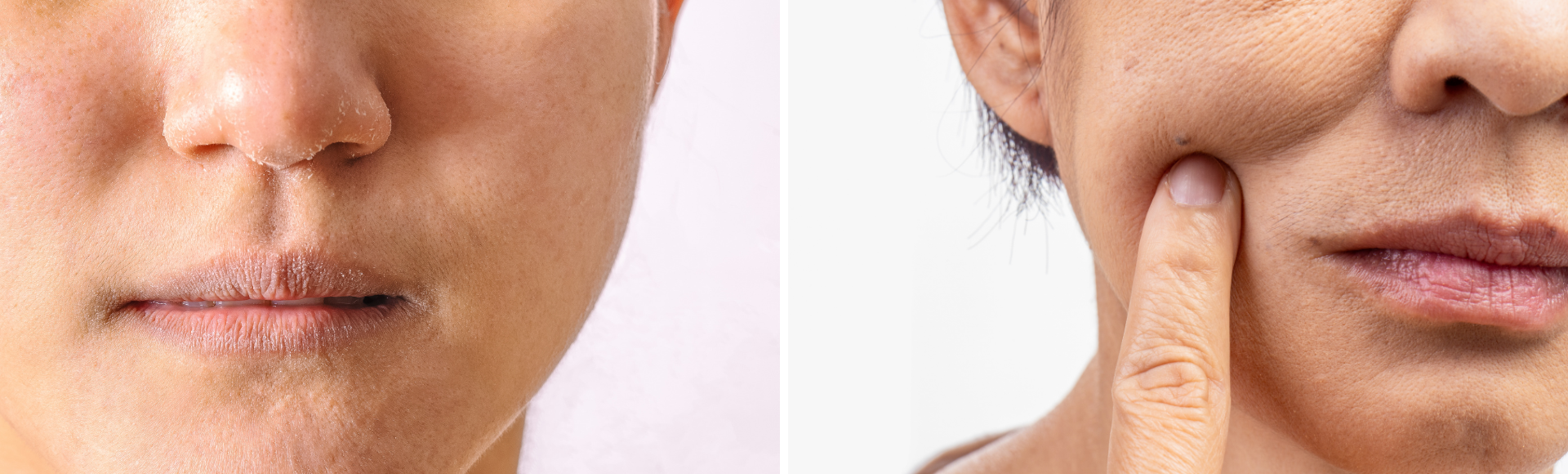 Dehydrated Skin vs. Dry Skin — How to Tell the Difference